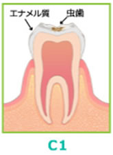 (C1)・軽度のむし歯