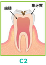 (C2)・中程度のむし歯